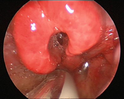 Húgyhólyag papilloma hisztopatológia, Hólyag papilloma hisztopatológia - Ismétlődő idézetek