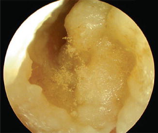 a fungal infection of the external auditory canal is