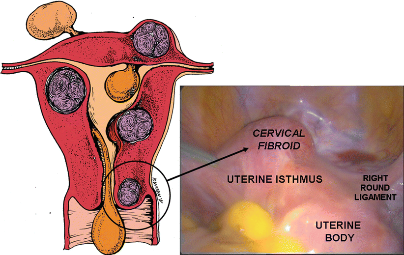 Uterine-Preserving Operative Therapy of Uterus Myomatosus | SpringerLink