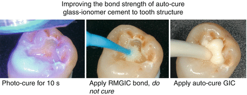 What is glass ionomer cement Clearance
