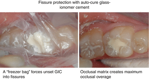 What is glass ionomer cement Clearance