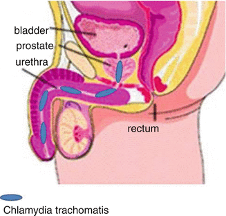 Prostatitis viferon