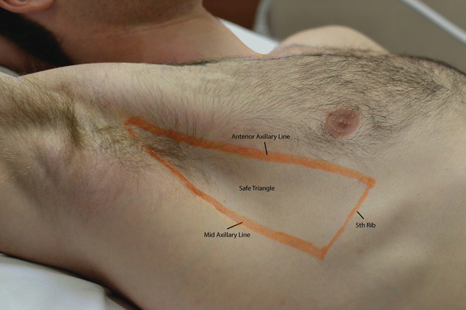 Needle Thoracostomy For Decompression Of Tension Pneumothorax Springerlink