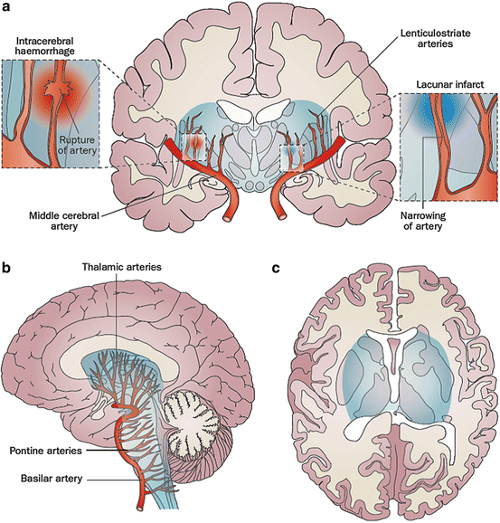 Hypertension and Stroke | SpringerLink