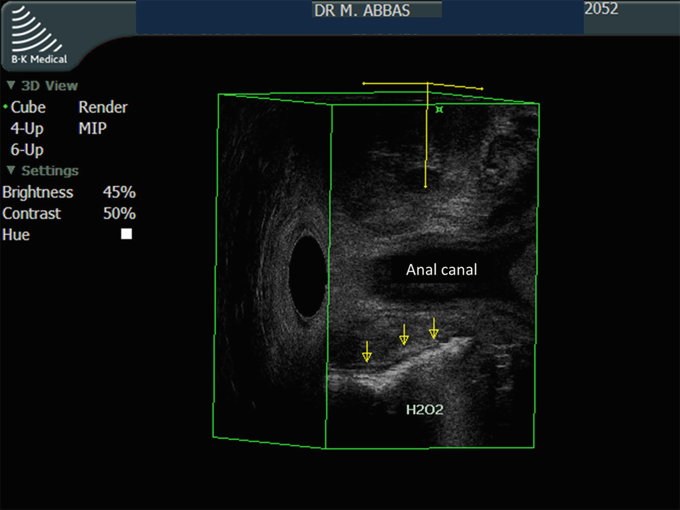 Complex Anorectal Fistulas Springerlink