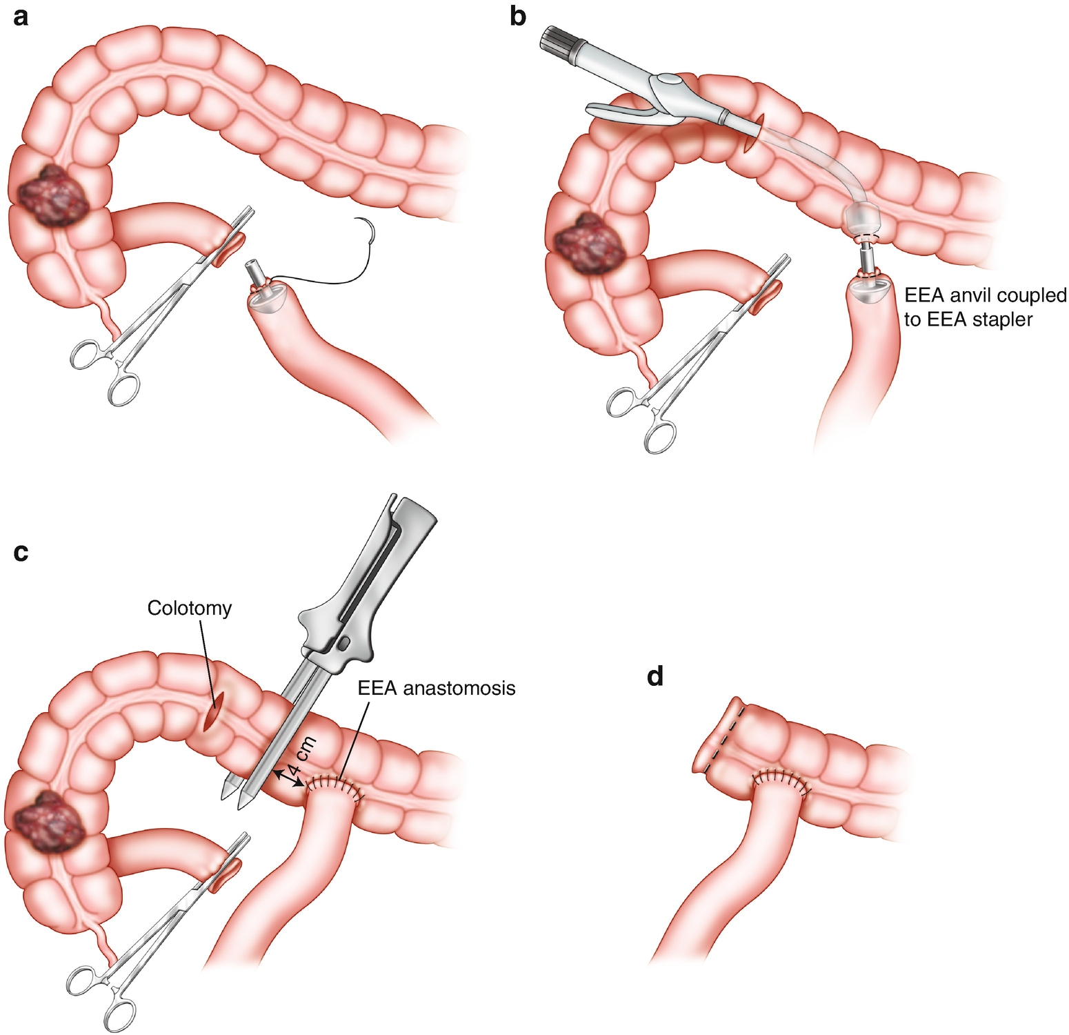 Anastomotic Construction Springerlink