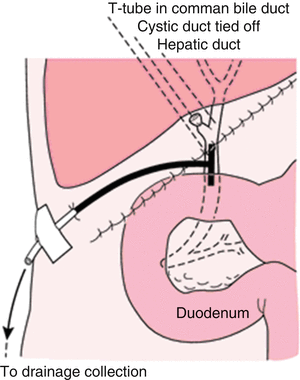 primary closure or t tube drainage after open or t tube drain