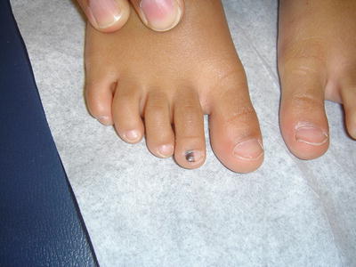 Nevi And Malignant Melanoma Springerlink