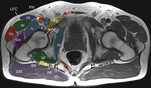Obturator Nerve Entrapment: Pelvic | SpringerLink