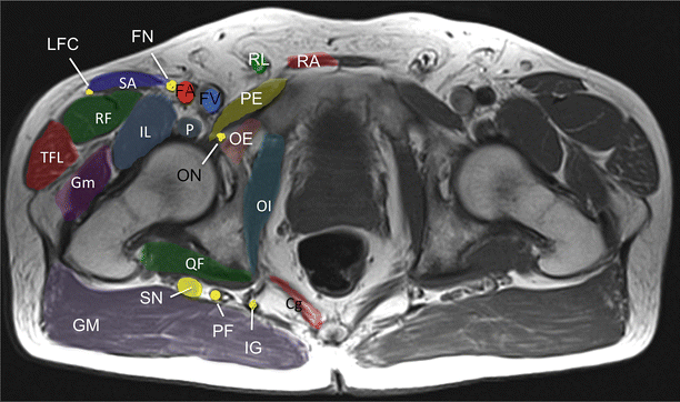 Proximal Sciatic Nerve Entrapment | SpringerLink