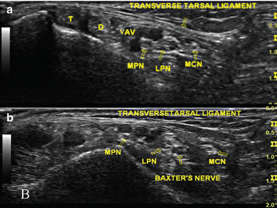 Medial Calcaneal Nerve Entrapment | SpringerLink