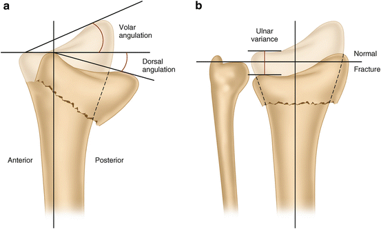 Angulation Vs Rotation Loss of Fixation in Distal Radius Fractures | SpringerLink