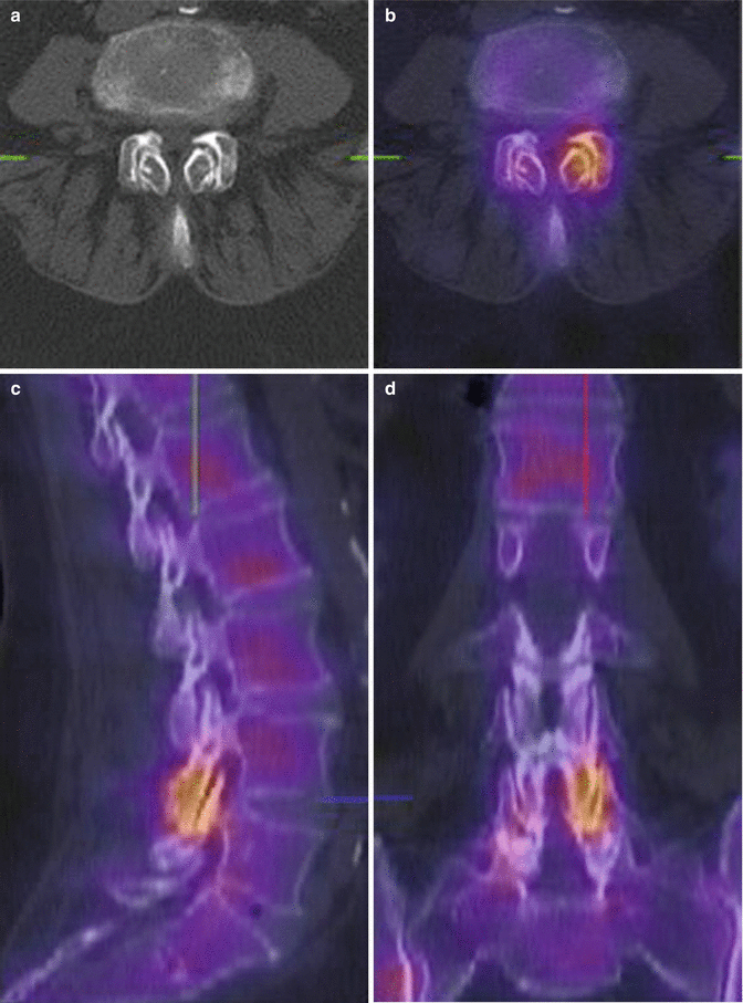 Medical Imaging of the Lumbar Facet Joint | SpringerLink