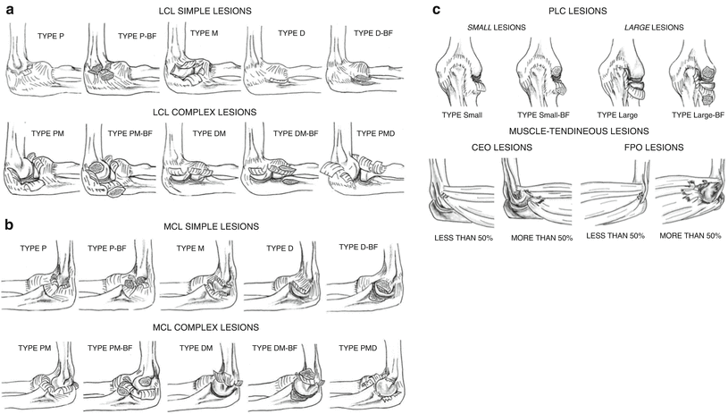 Complex Elbow Instability Treatment And Rehabilitation Springerlink