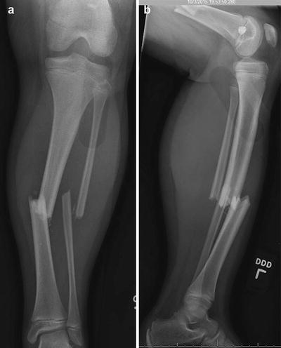 Floating Knee: Combined Femoral and Tibial Fractures ...