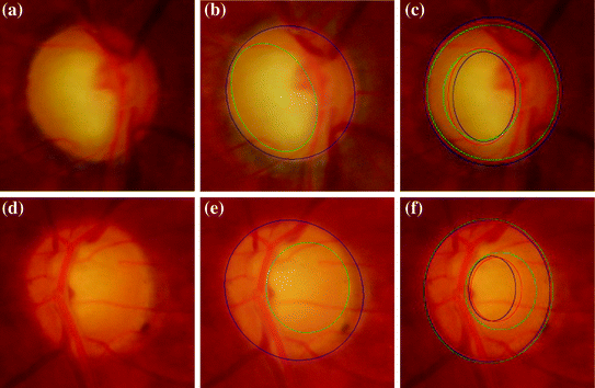 Semi Automated System For Cup To Disc Measurement For Diagnosing Glaucoma Using Classification Paradigm Springerlink