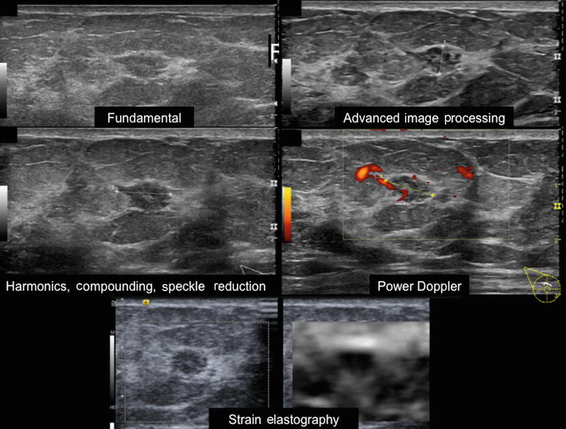 Breast Ultrasound BIRADS Update and Imaging Pathologic SpringerLink