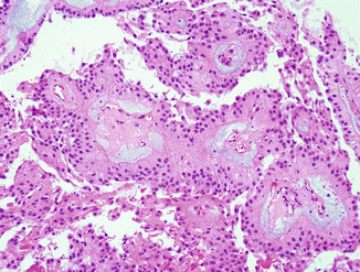pics Clear Cell Ependymoma Pathology Outlines ependymoma springerlink
