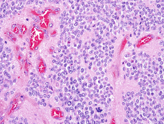 pics Clear Cell Ependymoma Pathology Outlines ependymoma springerlink