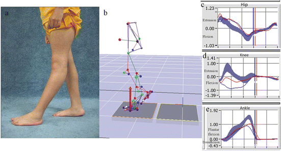 Stance Phase Problems In Cerebral Palsy Strength
