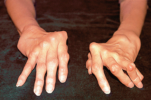 Pathogenesis, Clinical Syndromology and Treatment of