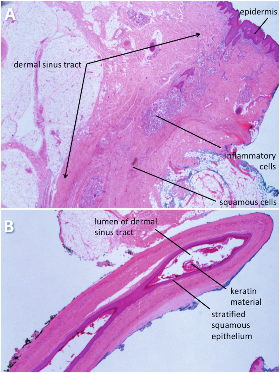 Limited Dorsal Spinal Nondisjunctional Disorders Limited Dorsal