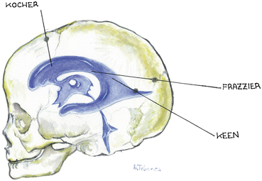 External Csf Shunts Springerlink