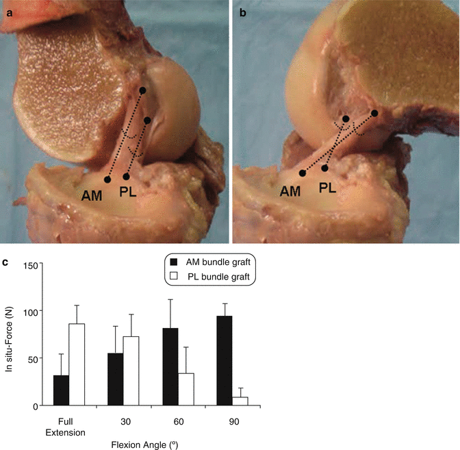 Double Bundle Anterior Cruciate Ligament Reconstruction Springerlink
