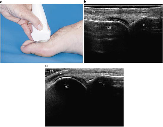 Ultrasound of the Ankle and Foot | SpringerLink