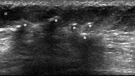 Ultrasound of the Subcutaneous Tissue | SpringerLink