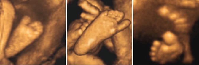 2d 3d 4d Ultrasound Of The Fetal Face In Genetic Syndromes Springerlink 2d 3d 4d Ultrasound Of The Fetal Face In Genetic Syndromes Springerlink