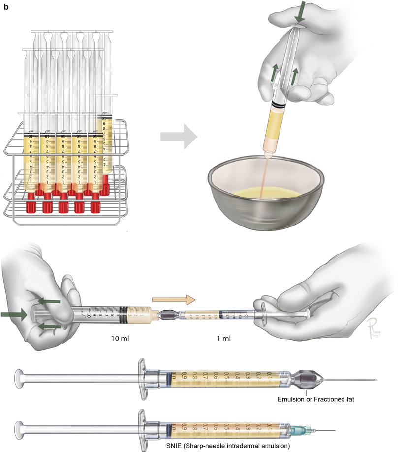 A Howto Guide on Structural Fat Grafting, Microfat Grafting, SharpNeedle Intradermal Fat