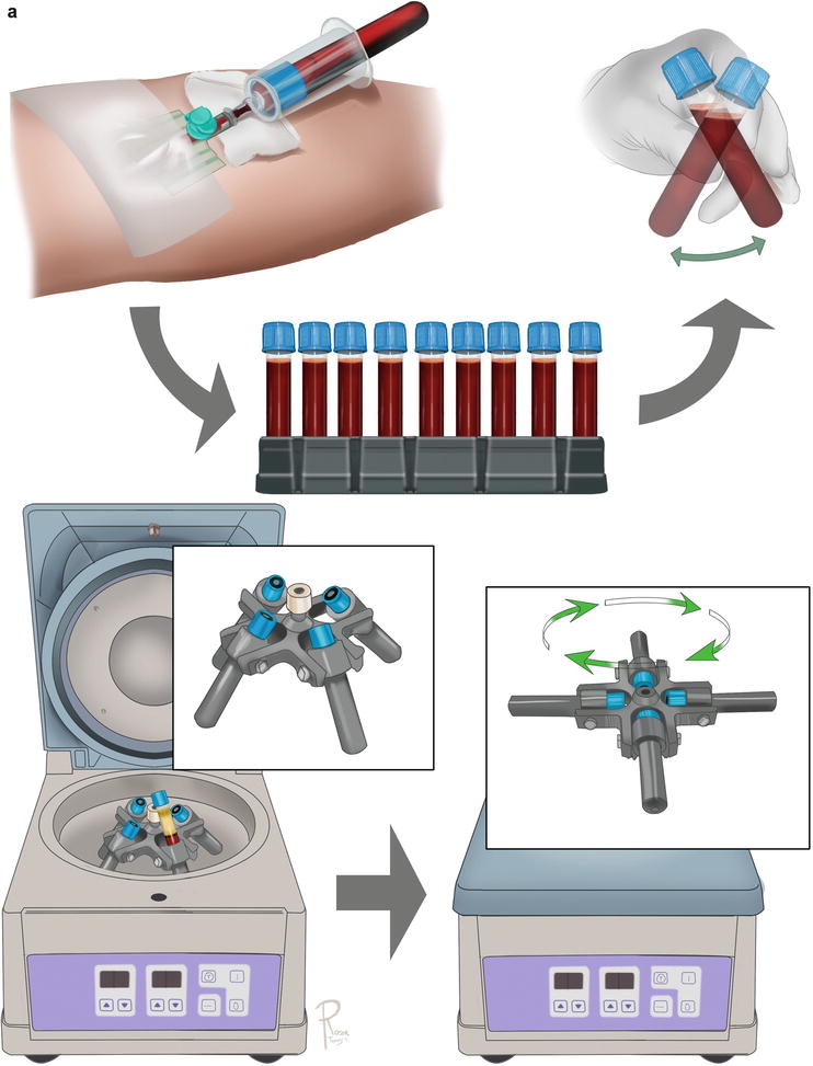 A Howto Guide on Structural Fat Grafting, Microfat Grafting, SharpNeedle Intradermal Fat