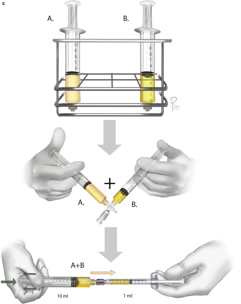 A Howto Guide on Structural Fat Grafting, Microfat Grafting, SharpNeedle Intradermal Fat