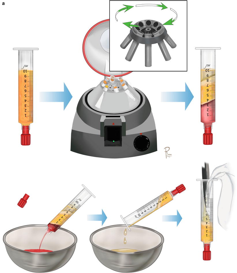 A Howto Guide on Structural Fat Grafting, Microfat Grafting, SharpNeedle Intradermal Fat