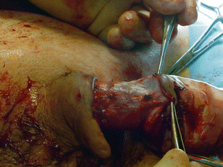 Glansectomy Pics