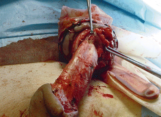 Glansectomy Pics