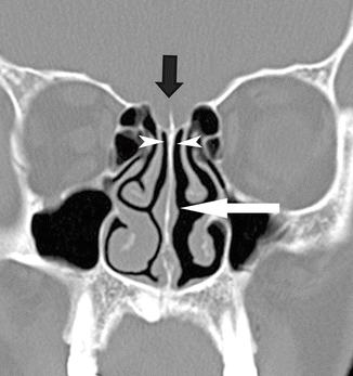 Sinonasal Tract – Anatomy and Histology | SpringerLink