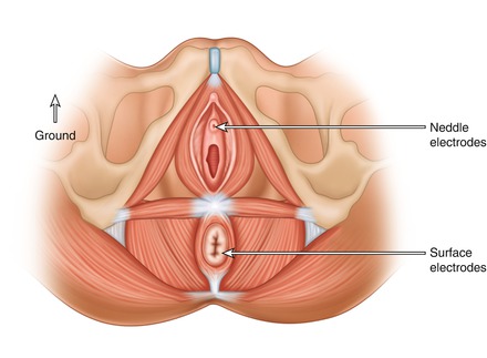 Electromyography Of Pelvic Floor Muscles Springerlink