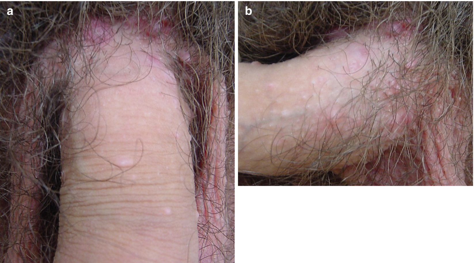 human papilloma virus in swahili