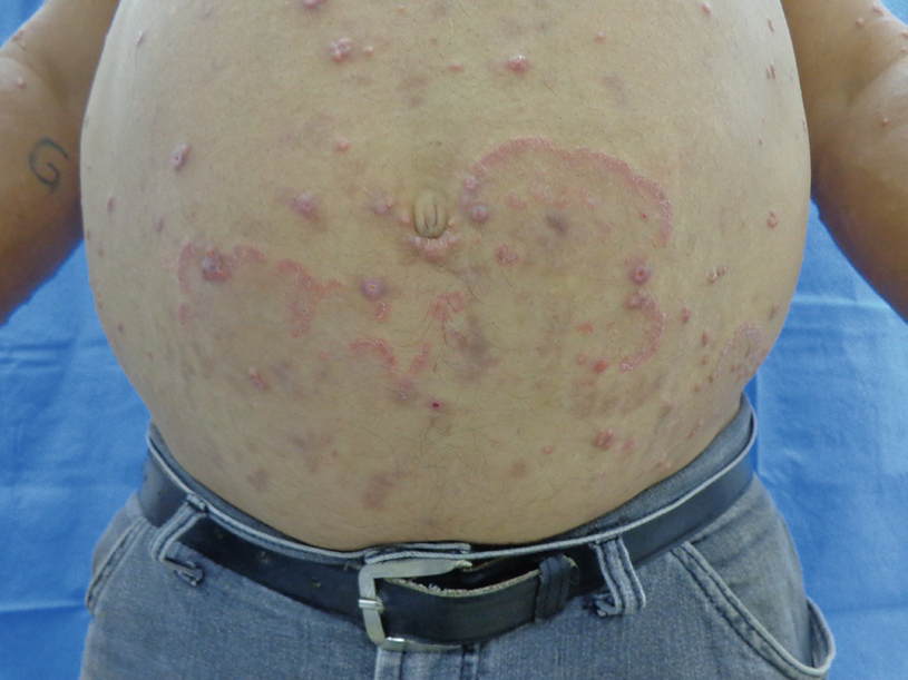 pityriasis versicolor 1177 pityriasis versicolor 1177