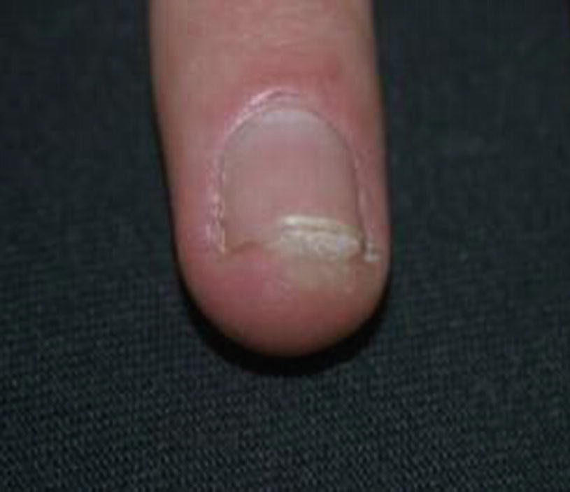 Nail Diseases Springerlink