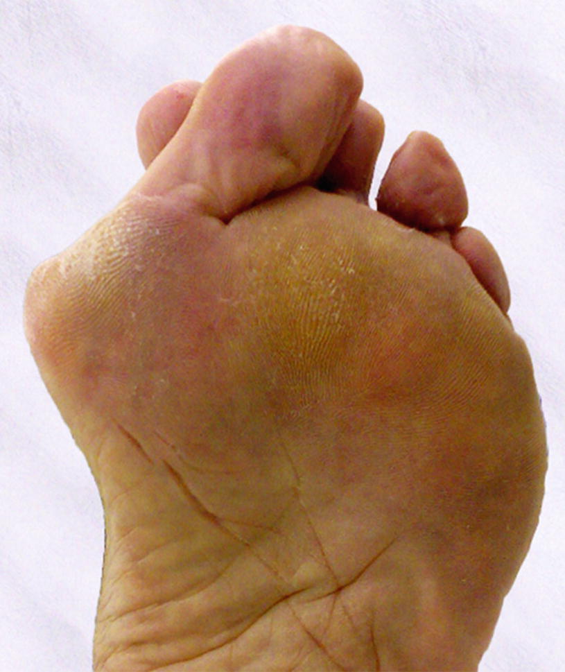 callosity foot