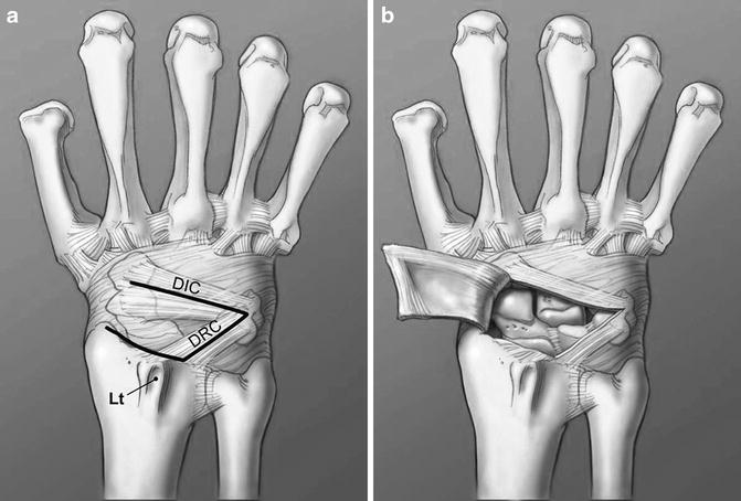 Proximal Row Carpectomy For The Treatment Of Kienbock S Disease Springerlink