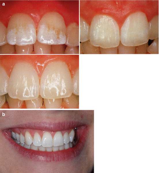 Enamel Microabrasion for Removal of Superficial Coloration and Surface