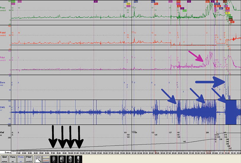 Video Urodynamics Springerlink