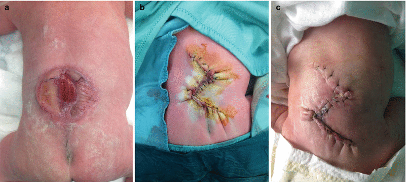 myelomeningocele repair surgical management based on a 30 year myelomeningocele repair