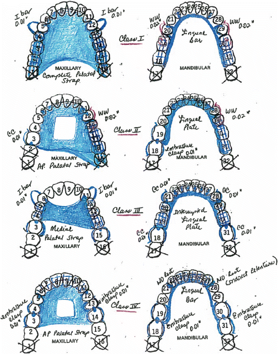 Removable Partial Dentures Rpd Treatment A Clinical Guide Springerlink