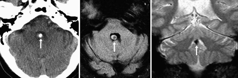 Choroid Plexus Normal Locations And Appearances Springerlink 7749