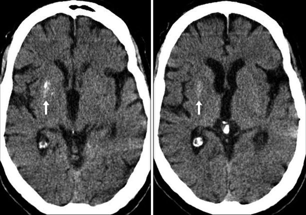 Basal Ganglia: Physiologic Calcifications | SpringerLink